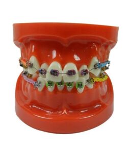 LD Study Model Ortho with Mini Implant - LD-087