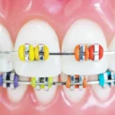 color-braces-los-angeles-1140x640-1.webp