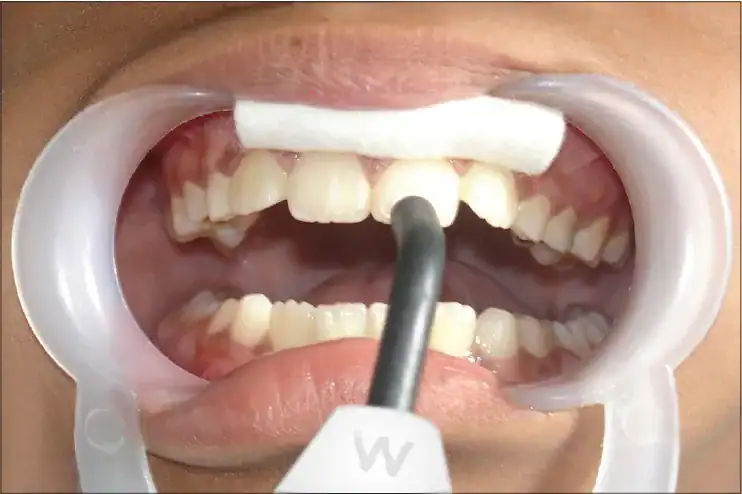 waldent_electric_pulp_tester.webp waldent_electric_pulp_tester.webp